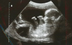 Can biological parents force a surrogate into an abortion?
